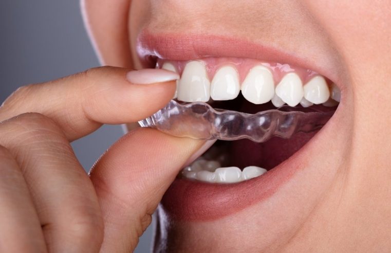 Елайнери Invisalign: переваги та можливості лікування в Тернополі