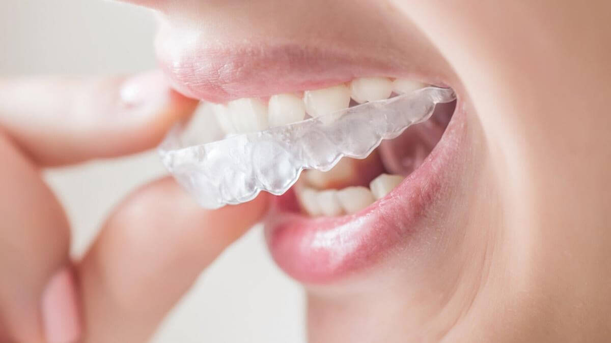 Інновації Invisalign: чому це прорив у сфері ортодонтії