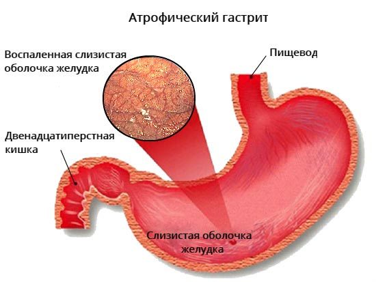 Атрофічний гастрит: дієта, харчування та лікування, меню на тиждень