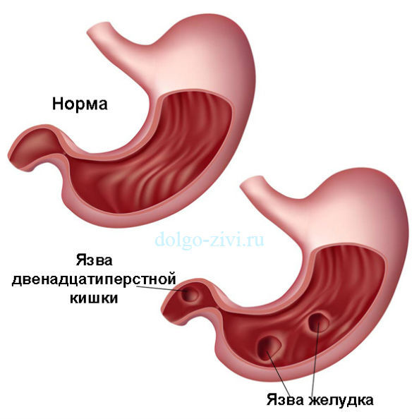 Капустяний сік: користь і шкода, як приймати, чи можна при гастриті і виразці