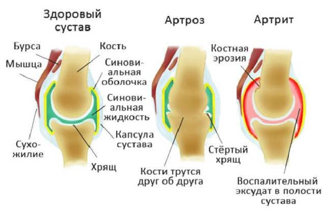 Ходьба на колінах: користь чи шкода, відгуки лікарів, відео