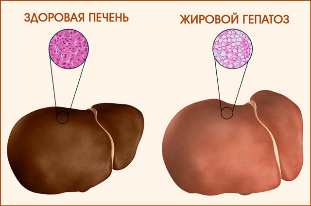 Жировий гепатоз печінки: дієта, лікування, меню на тиждень