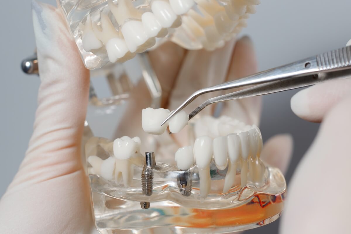 Імпланти зубів Київ