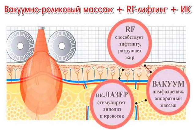 Вакуумный массаж результат фото