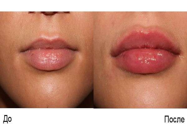 Набряк після збільшення губ гіалуроновою кислотою: скільки сходить, як зняти, відгуки