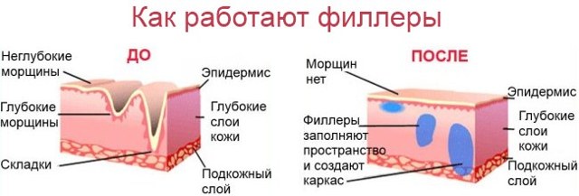 Вилиці гіалуроновою кислотою: фото до і після, плюси і мінуси, протипоказання, відгуки