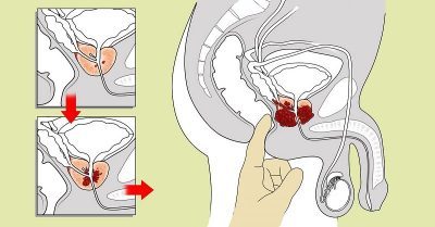 Масаж простати: користь і шкода, як робити в домашніх умовах, відгуки