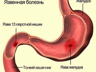 Вітамін Д при вагітності: чи можна пити, дозування, правила прийому