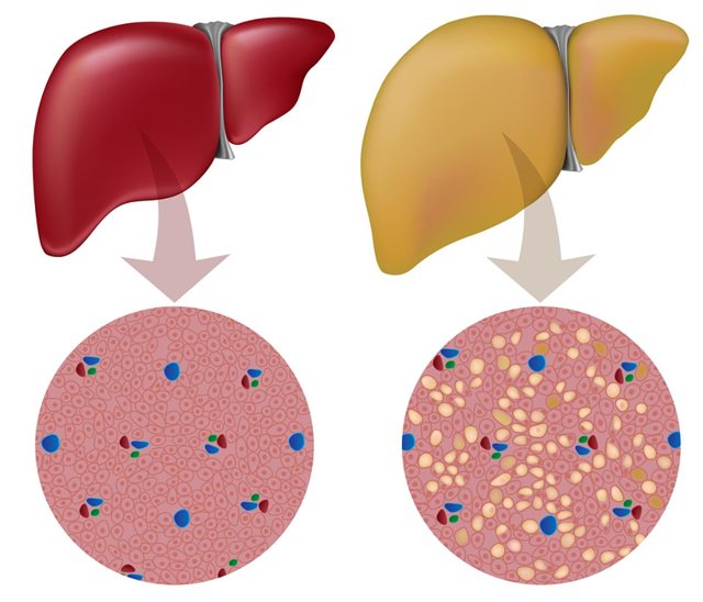 Жировий гепатоз печінки: дієта, лікування, меню на тиждень