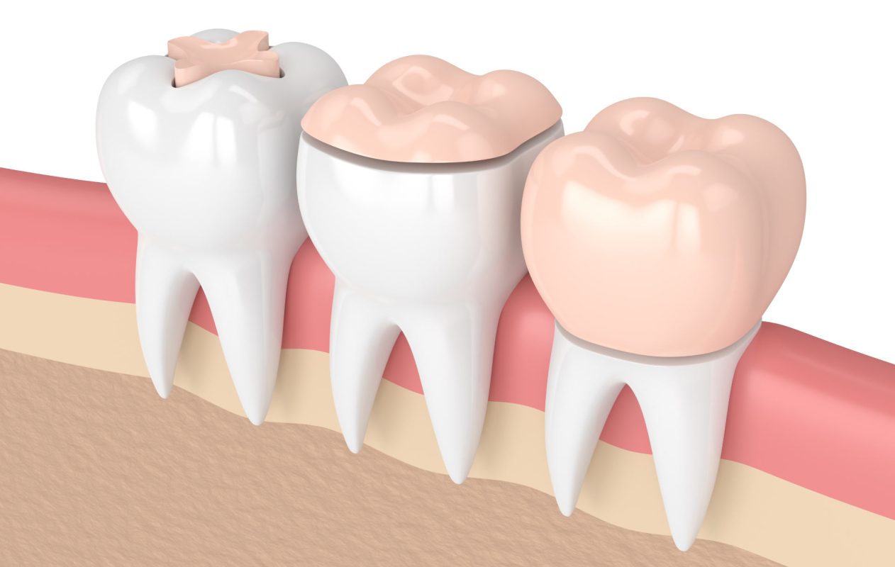 Что такое керамические вкладки на зубы