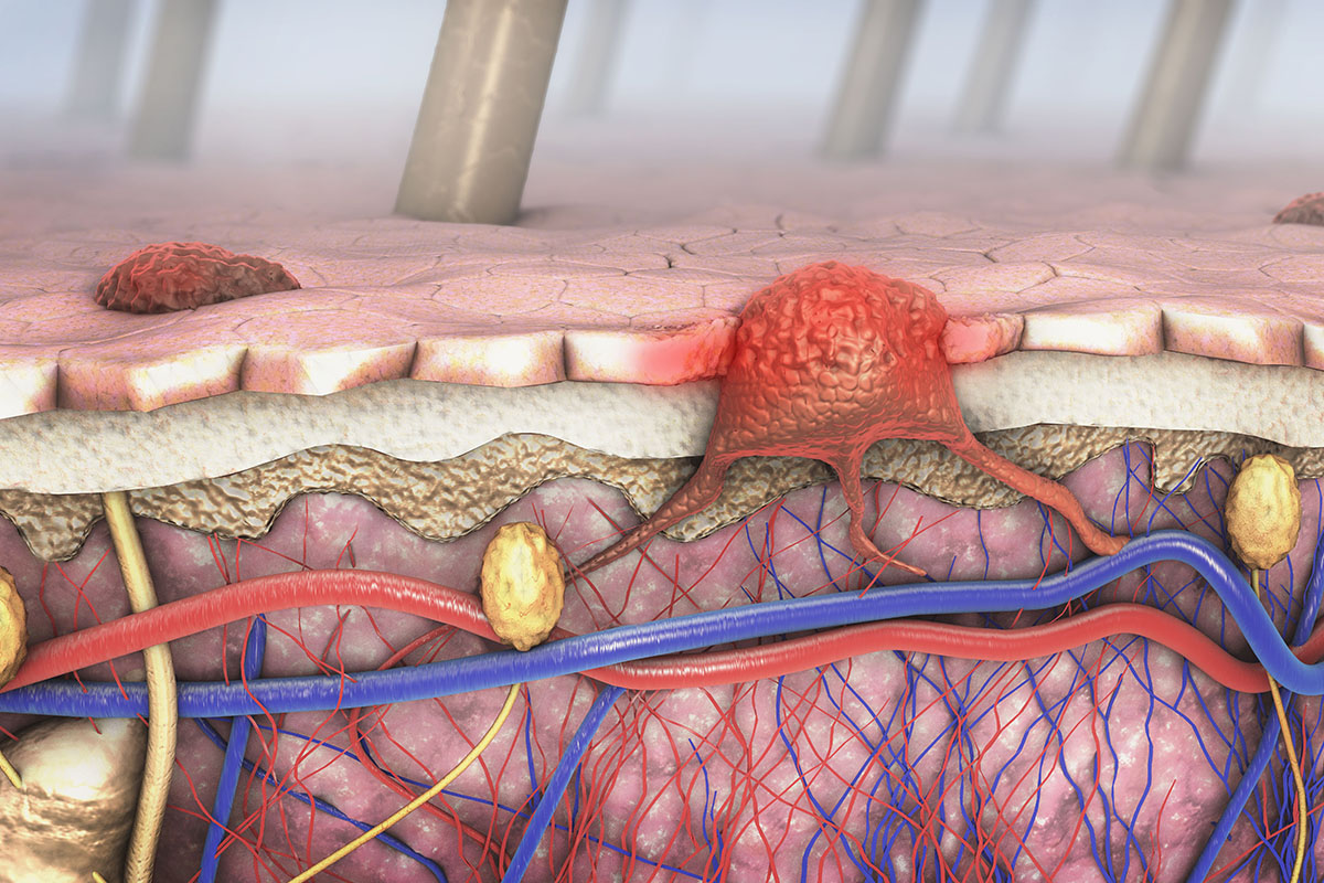 злокачественная опухоль на коже