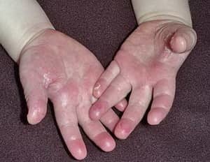 Облазив шкіра на пальцях: якого вітаміну не вистачає, як приймати