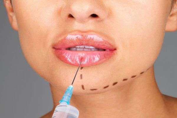 Набряк після збільшення губ гіалуроновою кислотою: скільки сходить, як зняти, відгуки