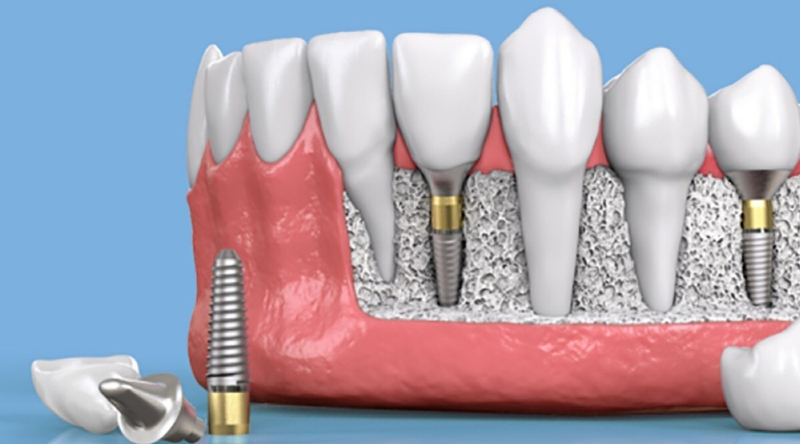 Схема установки зубных имплантов