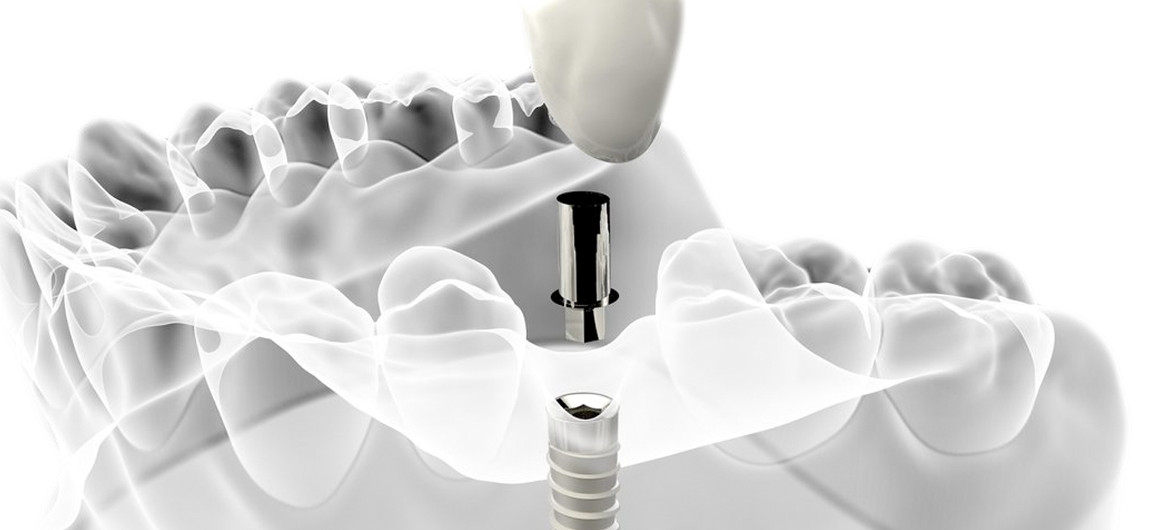 Рентгеновый снимок челюсти с имплантами