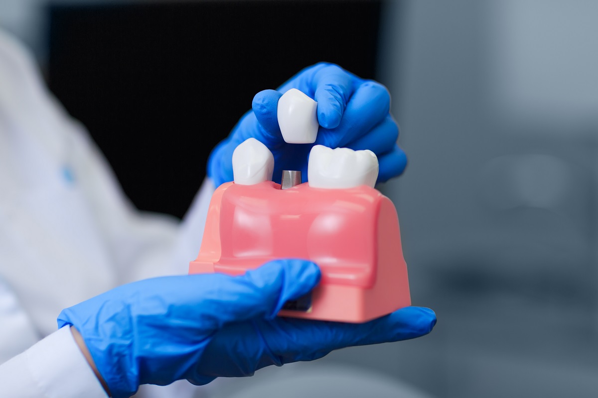 Переваги та недоліки імплантації зубів короткий лайфхак для тих, хто ще  роздумує