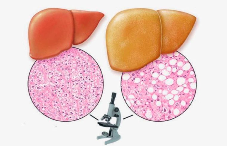 Жировий гепатоз печінки: дієта, лікування, меню на тиждень