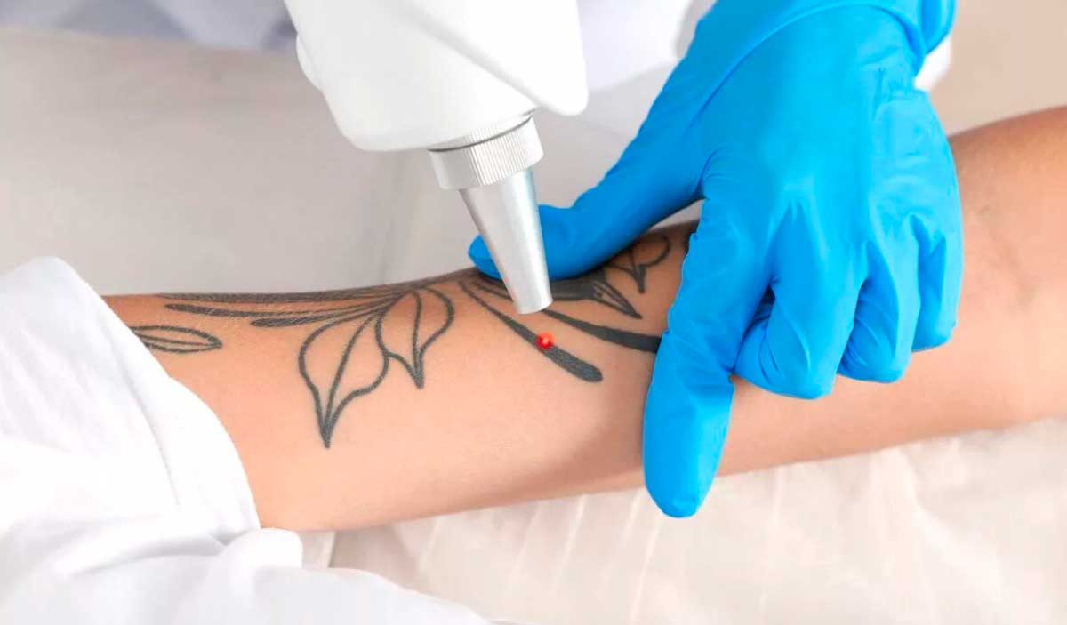 Основные преимущества лазерного удаления тату