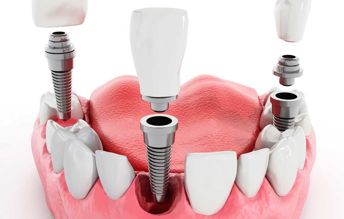 Приклад імплантації зубів нижньої щелепи людини