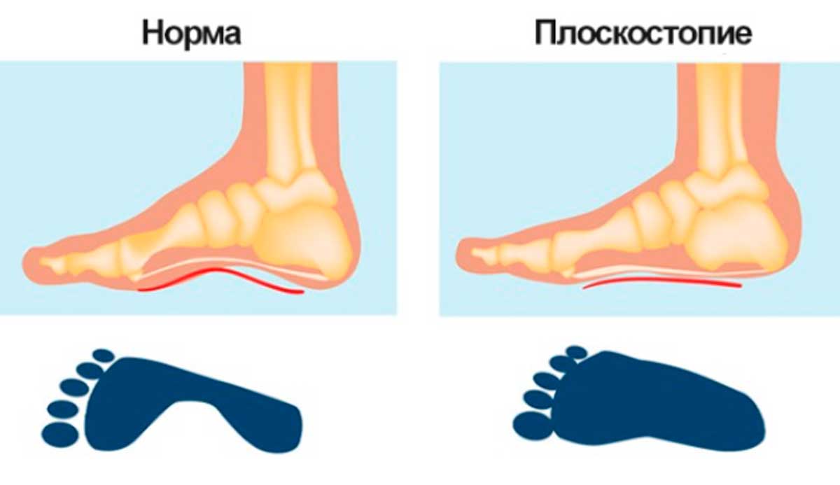 Последствия плоскостопия на здоровье - Olvi.ua