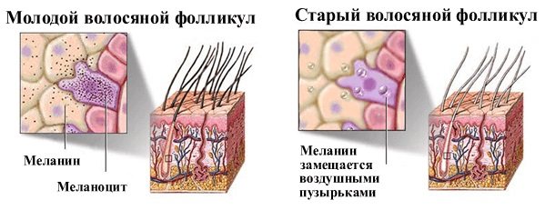 Як позбутися від сивини без фарбування, фарби, народні засоби, відтінків шампуні.  Причини ранньої сивини у чоловіків і жінок