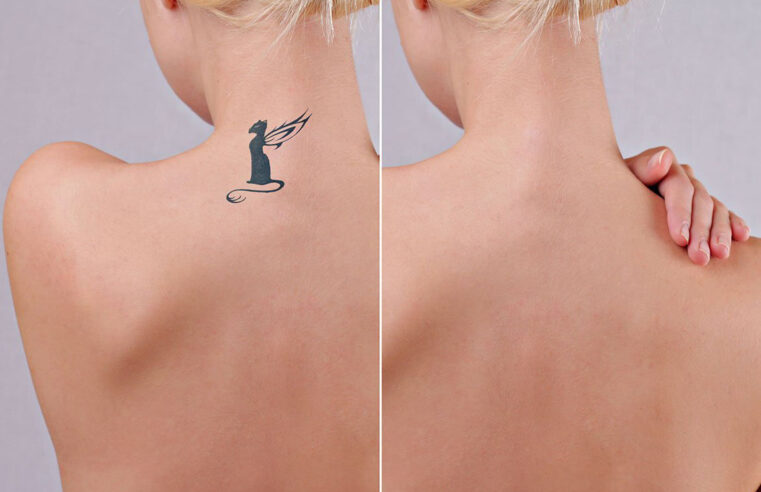 Лазерное удаление тату до и после