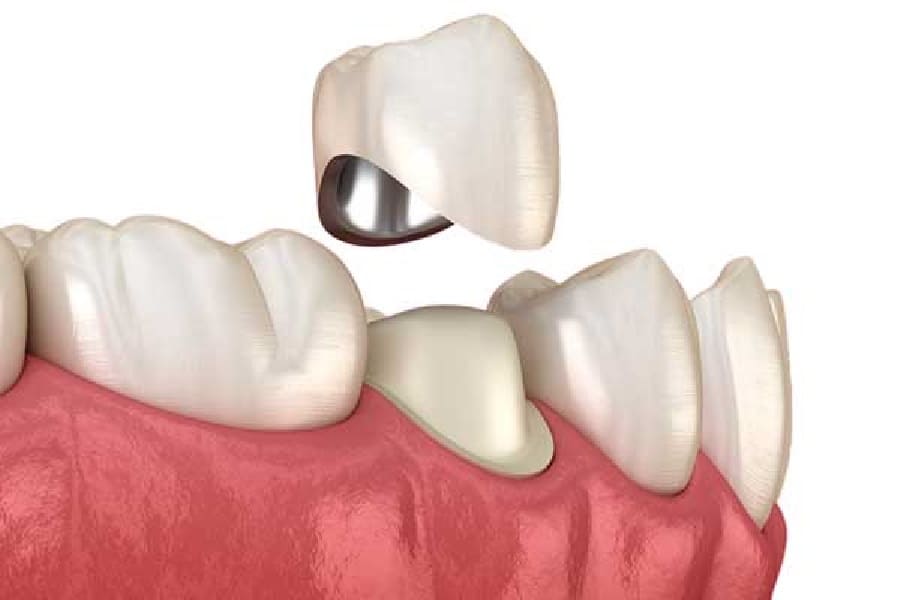 Керамічні коронки на зуб: Відновлення зубної естетики у клініці "Мій Стоматолог"