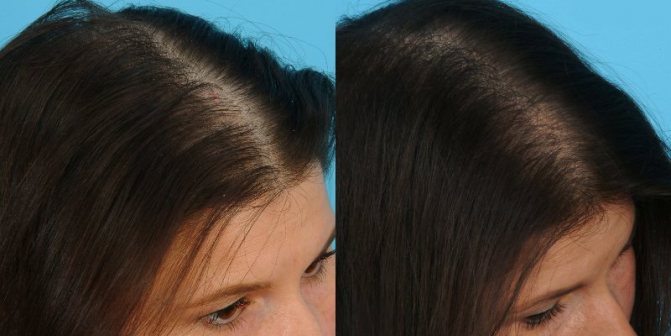 Мезотерапія для волосся: до і після