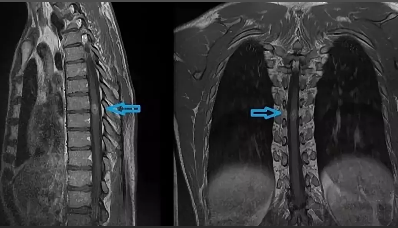 Опухоль спинного мозга мрт