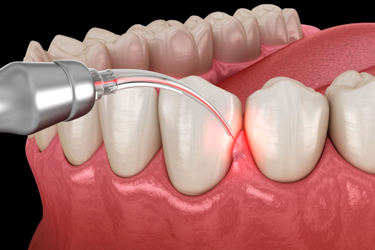 Гінгівопластика лазером при проблемах з яснами